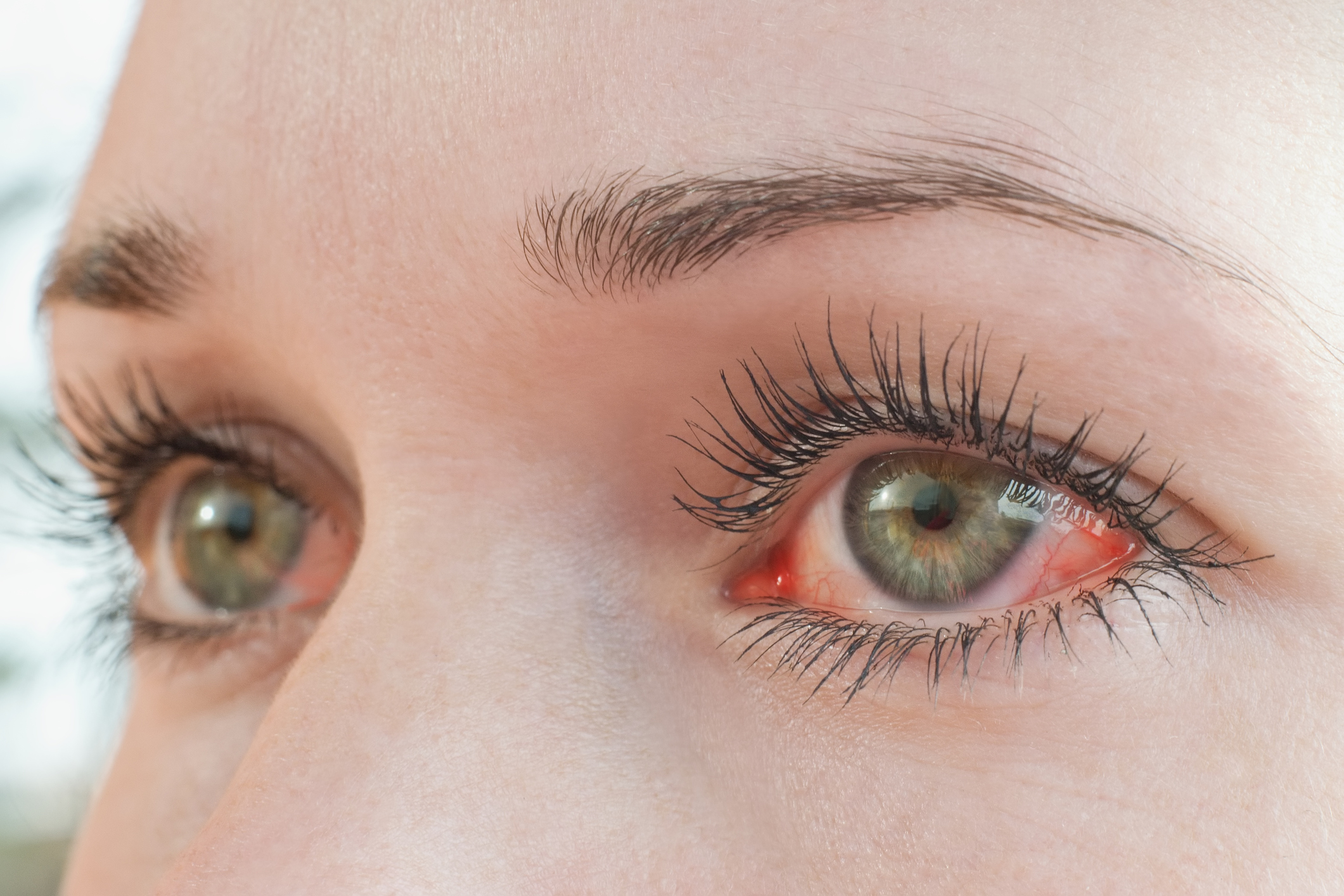 Dry Eye Treatment in Snowmass Village & Lone Tree, CO